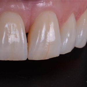 Лечение ,  протезирование и имплантация зубов в Полтаве на выгодных усл